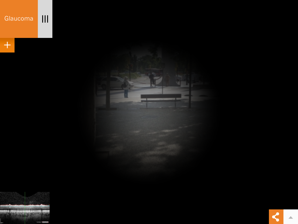 Glaucoma