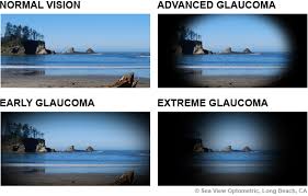 glaucoma zaragoza