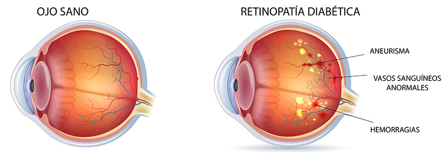 Retinopatia diabetica esquema